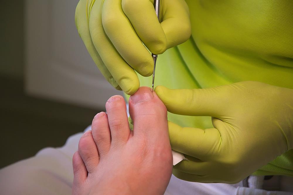 Ingrown Toenails  Anaheim, CA, 