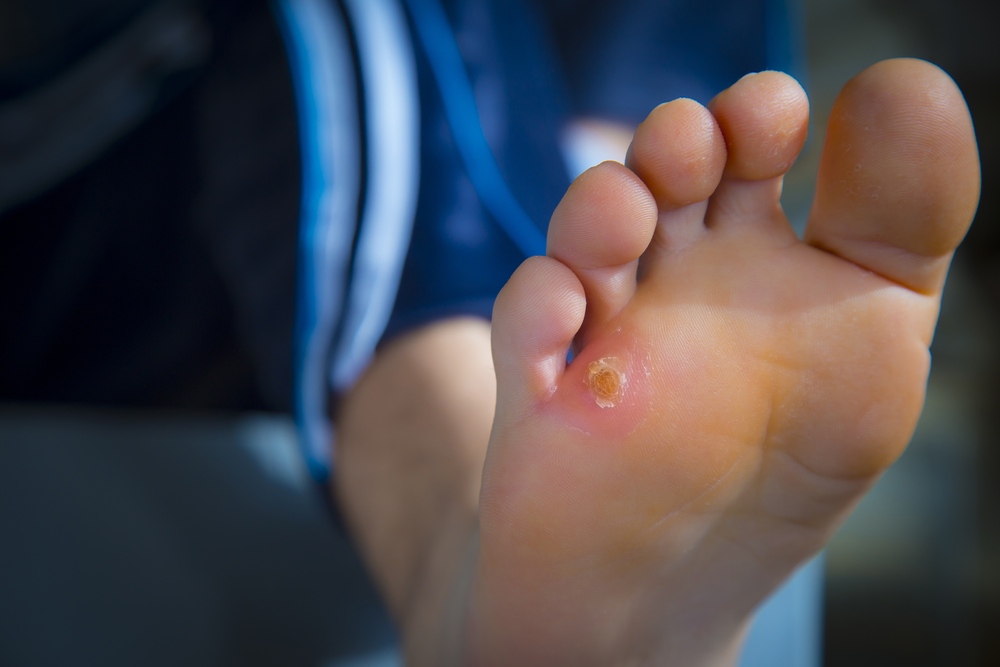 Wound Care  Anaheim, CA, 