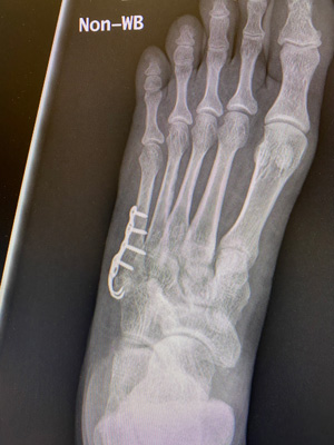 post-op-image09