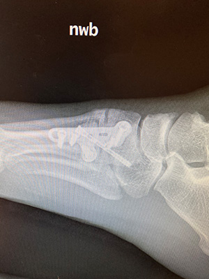 post-op-image13