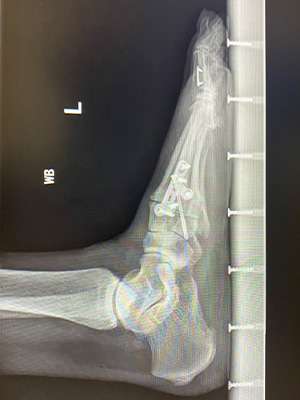post-op-image23
